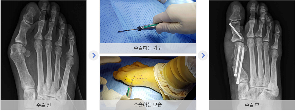 수술전사진 - 수술하는기구사진 수술하는 모습 사진 - 수술후사진