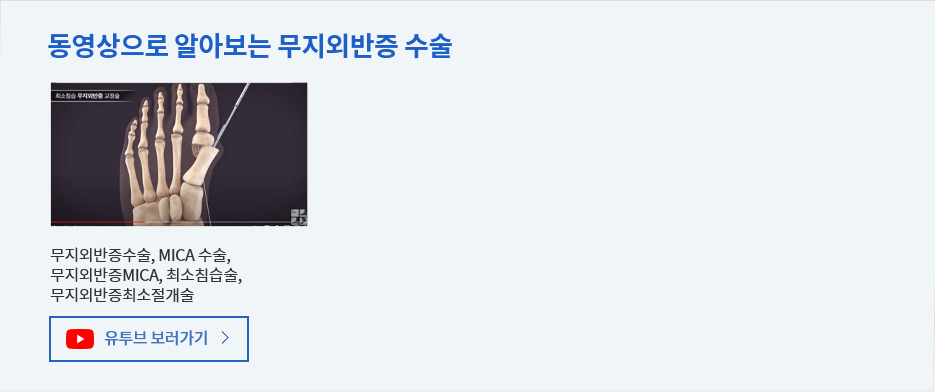 동영상으로 알아보는 무지외반증 수술