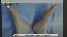 최경진정형외과 최소절개,최소침습수술 MICA